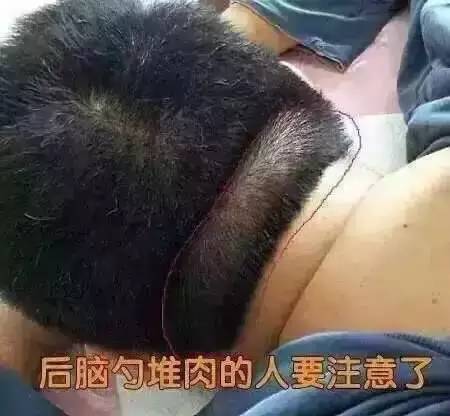 后脑勺堆肉,竟是脑梗的前兆!自己赶快对照看看